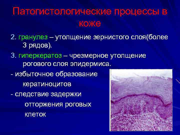 Патогистологические процессы в коже 2. гранулез – утолщение зернистого слоя(более 3 рядов). 3. гиперкератоз