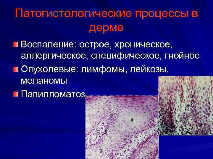 Патогистологические процессы в дерме Воспаление: острое, хроническое, аллергическое, специфическое, гнойное Опухолевые: лимфомы, лейкозы, меланомы
