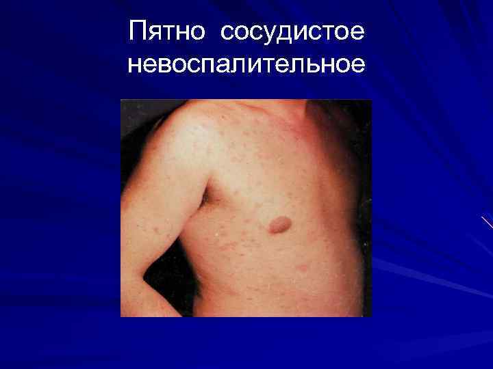 Пятно сосудистое невоспалительное 