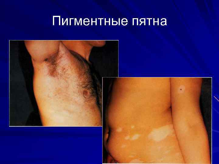 Пигментные пятна 