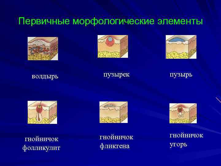 Первичные морфологические элементы волдырь гнойничок фолликулит пузырек гнойничок фликтена пузырь гнойничок угорь 