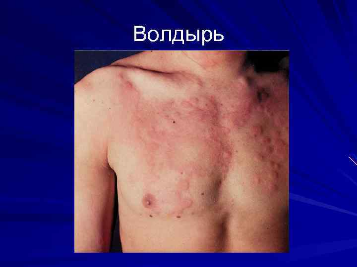 Волдырь 