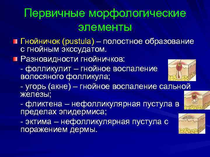 Первичные морфологические элементы Гнойничок (pustula) – полостное образование с гнойным экссудатом. Разновидности гнойничков: -