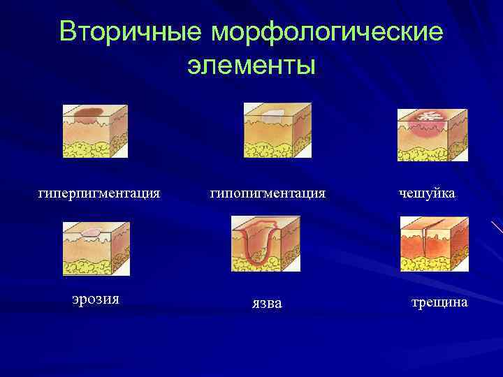 Вторичные морфологические элементы гиперпигментация гипопигментация эрозия язва чешуйка трещина 