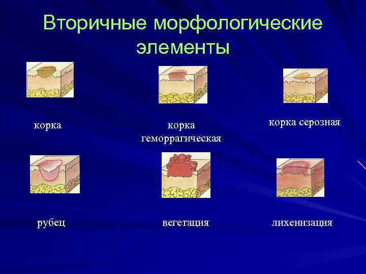Вторичные морфологические элементы корка рубец корка геморрагическая вегетация корка серозная лихенизация 