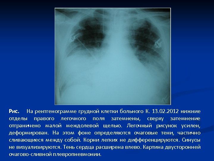 Рис. На рентгенограмме грудной клетки больного К. 13. 02. 2012 нижние отделы правого легочного