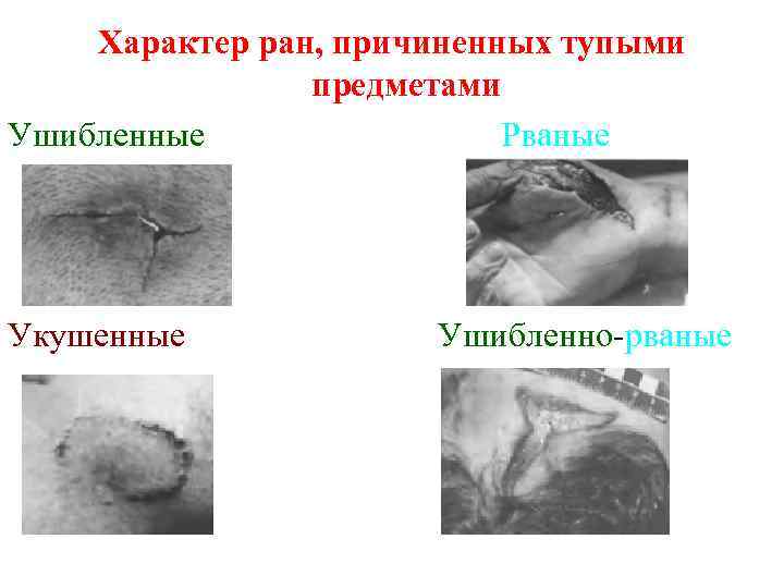 Характер ран, причиненных тупыми предметами Ушибленные Рваные Укушенные Ушибленно-рваные 