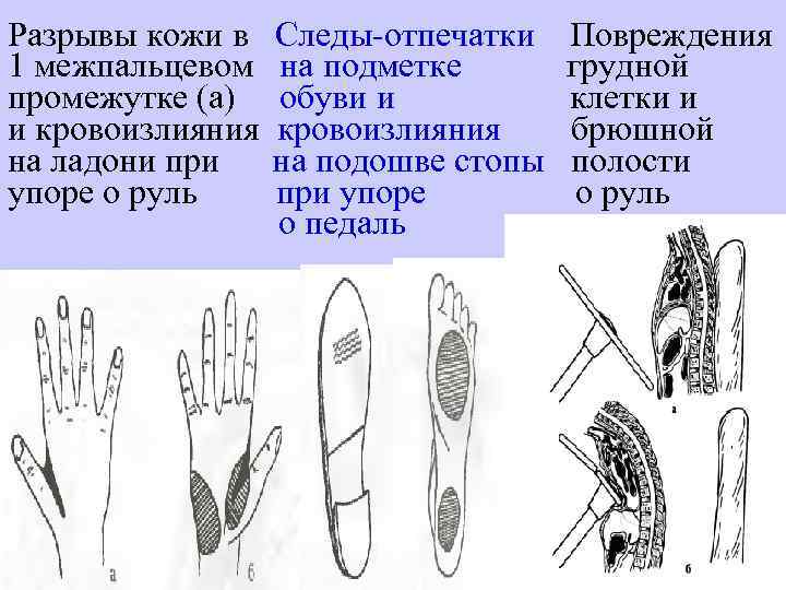 Разрывы кожи в 1 межпальцевом промежутке (а) и кровоизлияния на ладони при упоре о