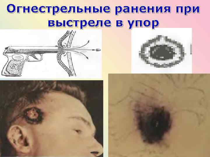 Огнестрельные ранения при выстреле в упор 