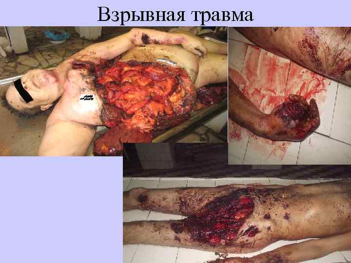 Взрывная травма 