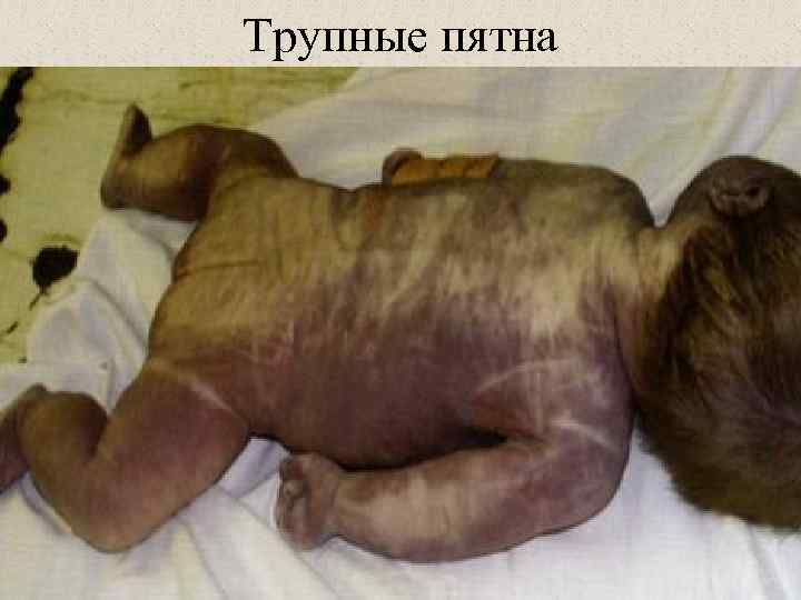 Трупные пятна 