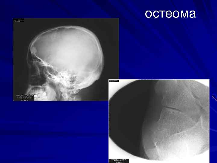 остеома 