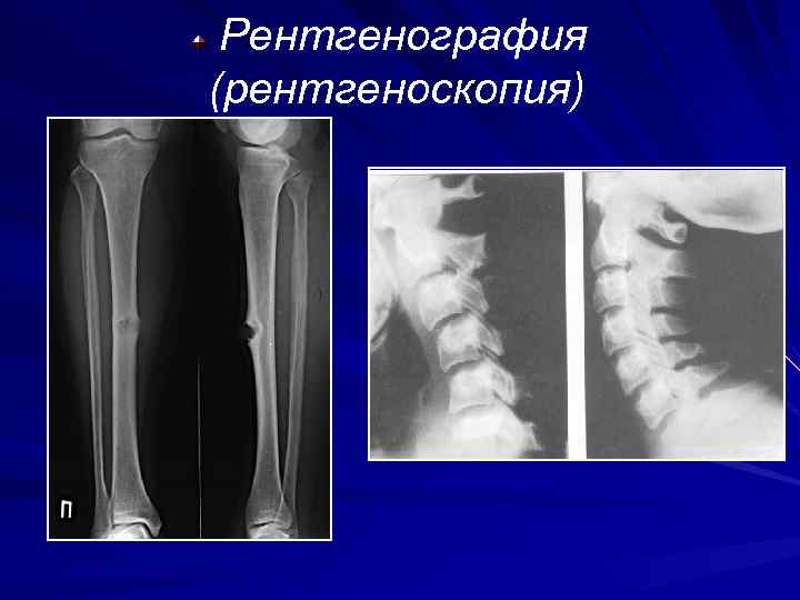 При электрорентгенографии изображение получают