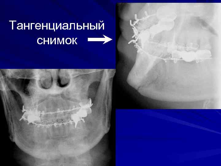 Тангенциальный снимок 
