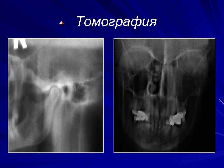 Томография 