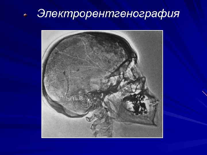 При электрорентгенографии изображение получают