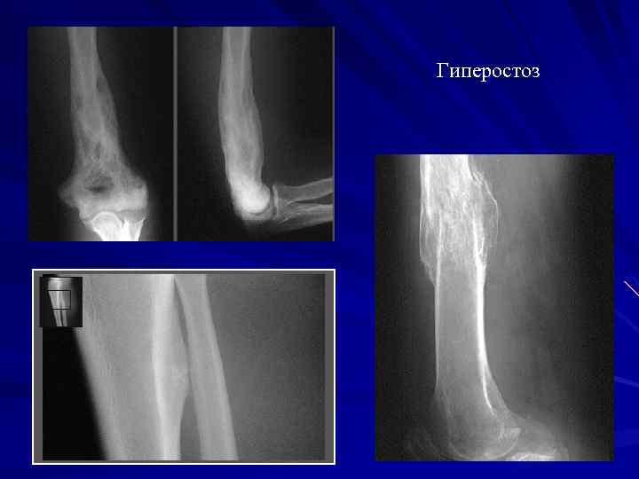 Гиперостоз 