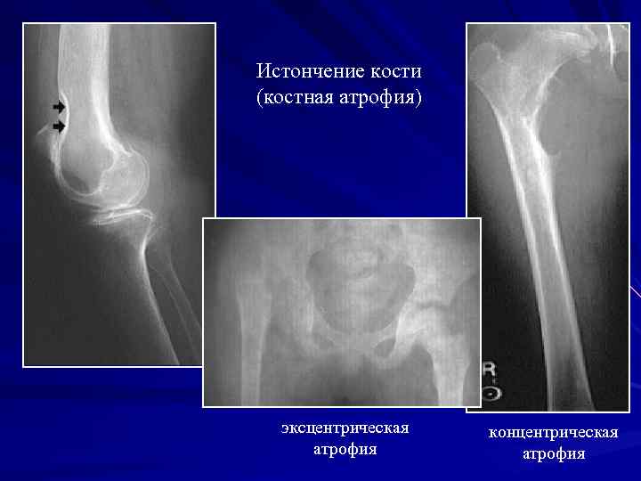 Истончение кости (костная атрофия) эксцентрическая атрофия концентрическая атрофия 