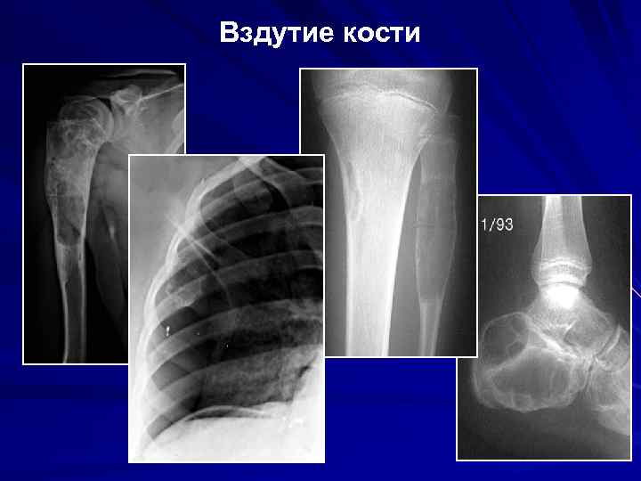 Вздутие кости 