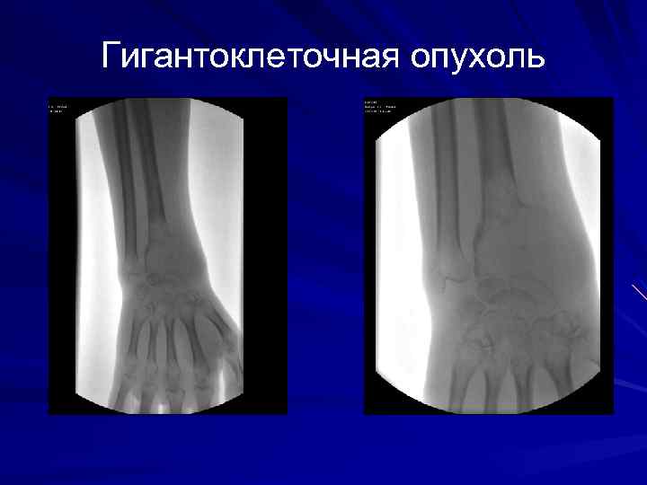 Для рентгенологической картины кистозной формы гигантоклеточной опухоли характерно