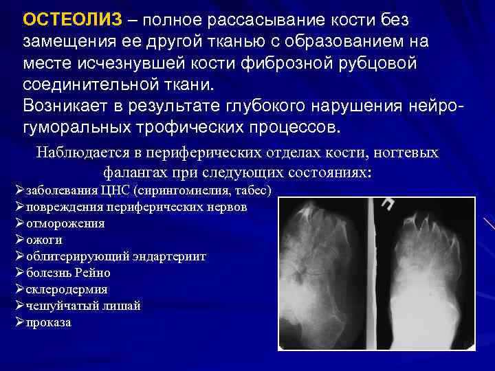 Остеолиз это. Остеолиз рентгенологические признаки. Остеолизис на рентгенограмме. Остеолиз костей рентгенодиагностика.