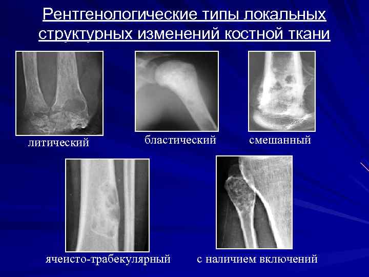 Трабекулярный рисунок кости