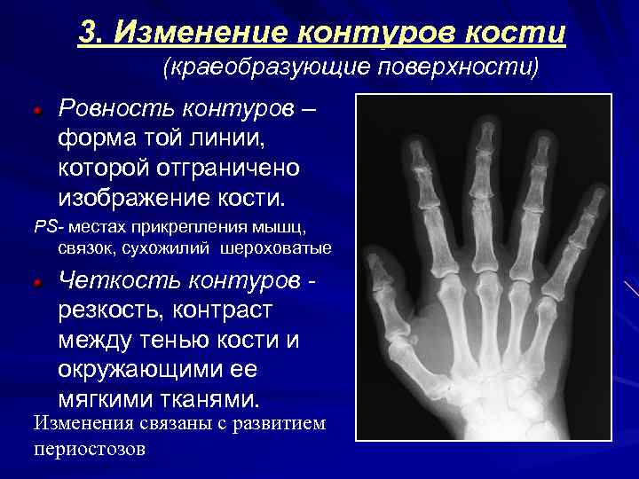 3. Изменение контуров кости (краеобразующие поверхности) Ровность контуров – форма той линии, которой отграничено