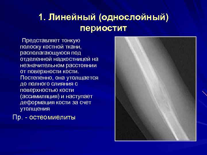 1. Линейный (однослойный) периостит Представляет тонкую полоску костной ткани, располагающуюся под отделенной надкостницей на