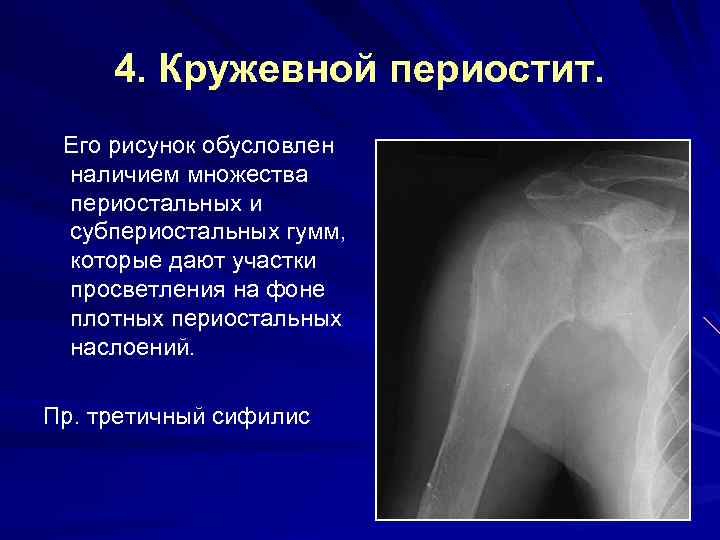 Треугольник крейбиха гистологическая картина