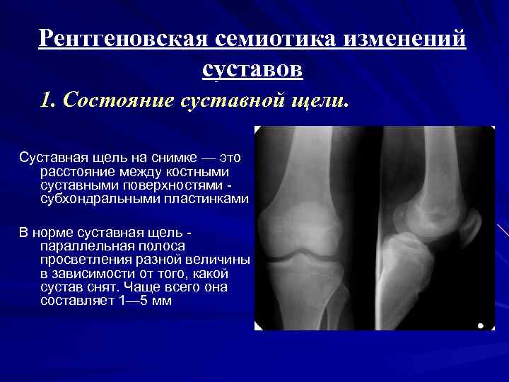 Сустав норма. Расширение суставной щели рентген. Рентгеновская суставная щель коленного сустава норма. Рентгеновская суставная щель норма. Рентгеновская суставная щель дает на рентгенограмме.