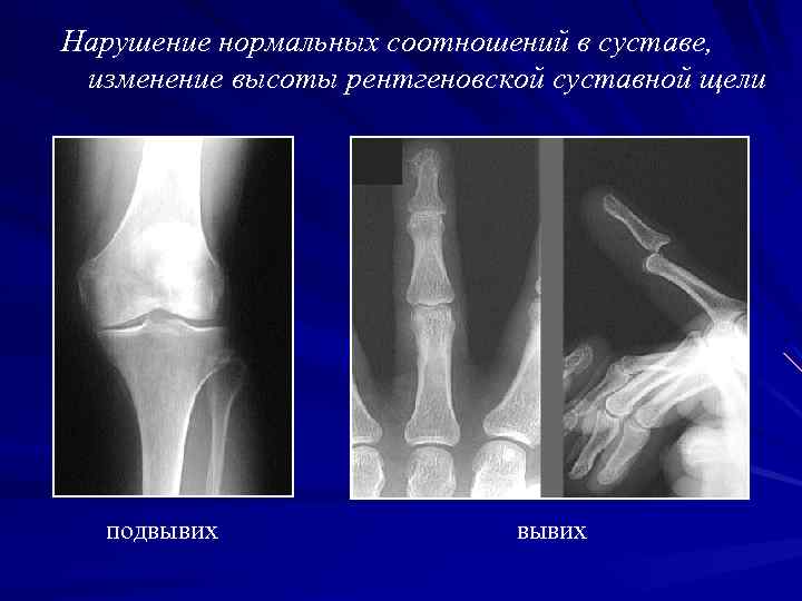 Нарушение нормальных соотношений в суставе, изменение высоты рентгеновской суставной щели подвывих 
