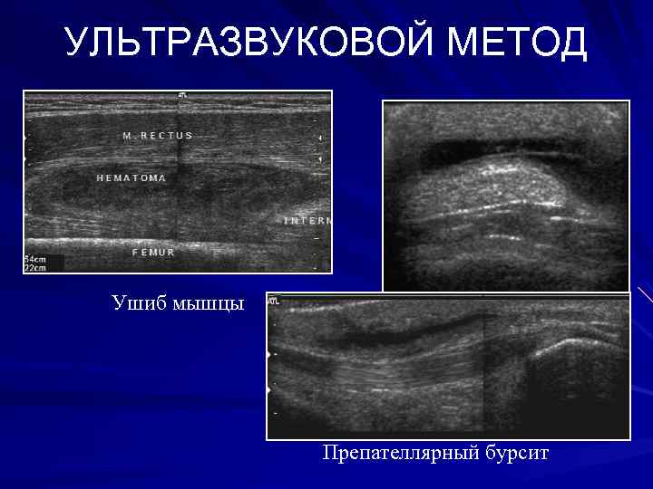 УЛЬТРАЗВУКОВОЙ МЕТОД Ушиб мышцы Препателлярный бурсит 