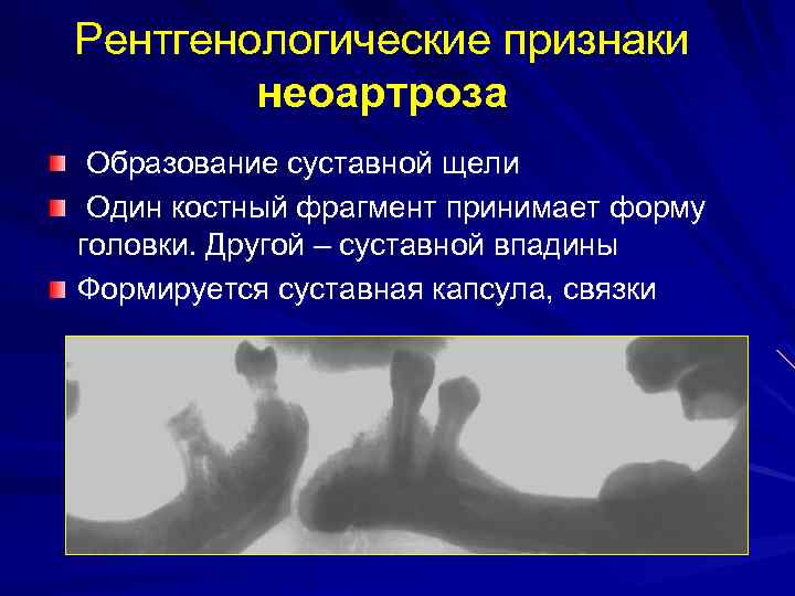 Рентгенологические признаки неоартроза Образование суставной щели Один костный фрагмент принимает форму головки. Другой –