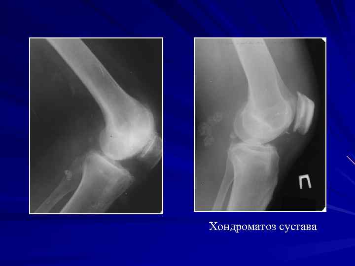 Хондроматоз сустава 