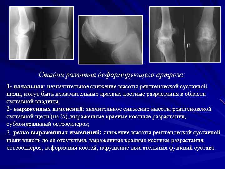 Остеосклероз суставов