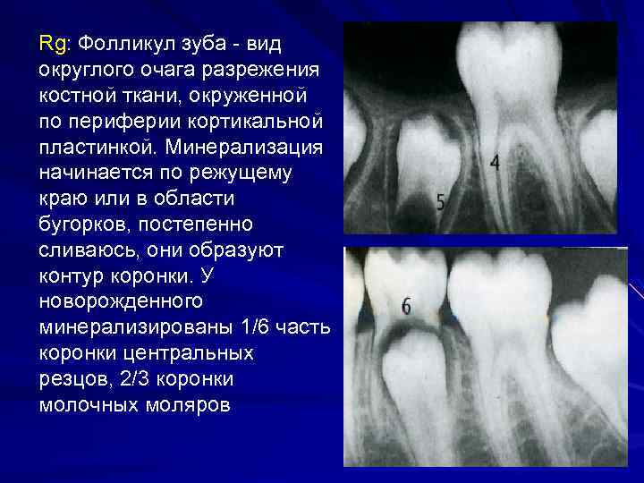 Разряжение костной ткани. Очаг разряжения костной структуры что это. Очаг деструкции костной ткани зуба что это такое. Очаговое разряжение костной ткани.