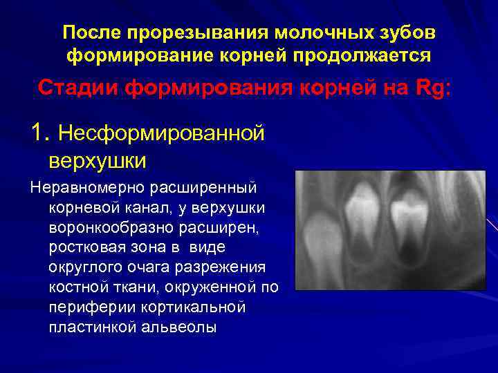 Несформированные корни периодонтит лечение