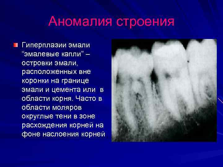 Аномалии список. Основные клинические формы гиперплазии зубов:. Гиперплазия эмали зубов.