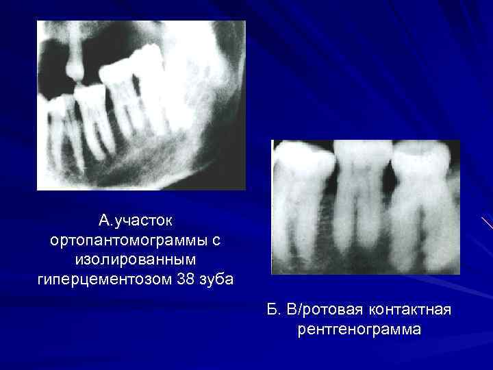 Гиперцементоз корня зуба фото