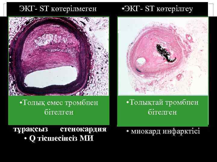 ЭКГ- ST көтерілмеген • ЭКГ- ST көтерілгеy • Толық емес тромбпен бітелген • Толықтай