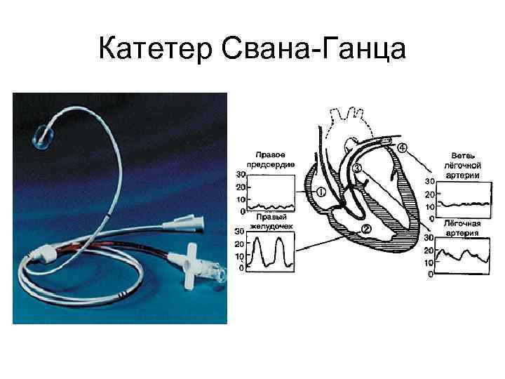 Катетер Свана-Ганца 