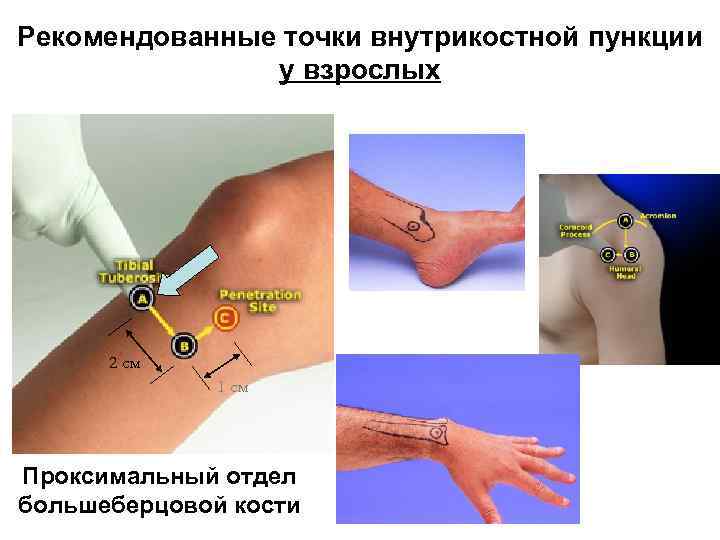 Рекомендованные точки внутрикостной пункции у взрослых 2 см 1 см Проксимальный отдел большеберцовой кости