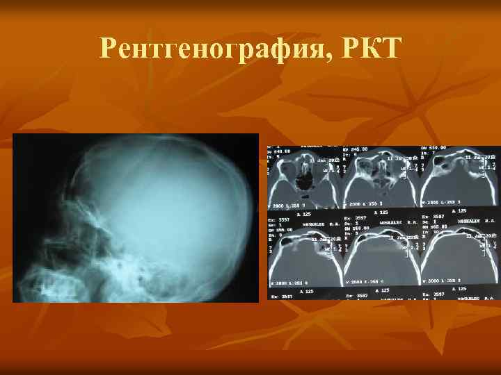 Рентгенография, РКТ 