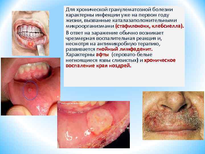 Для хронической гранулематозной болезни характерны инфекции уже на первом году жизни, вызванные каталазаположительными микроорганизмами