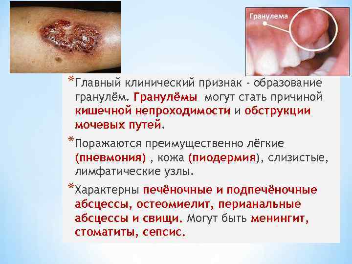 *Главный клинический признак - образование гранулём. Гранулёмы могут стать причиной кишечной непроходимости и обструкции