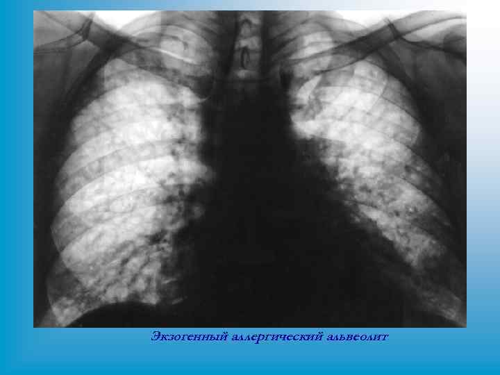 Экзогенный аллергический альвеолит 