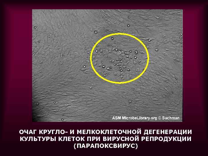 ОЧАГ КРУГЛО- И МЕЛКОКЛЕТОЧНОЙ ДЕГЕНЕРАЦИИ КУЛЬТУРЫ КЛЕТОК ПРИ ВИРУСНОЙ РЕПРОДУКЦИИ (ПАРАПОКСВИРУС) 