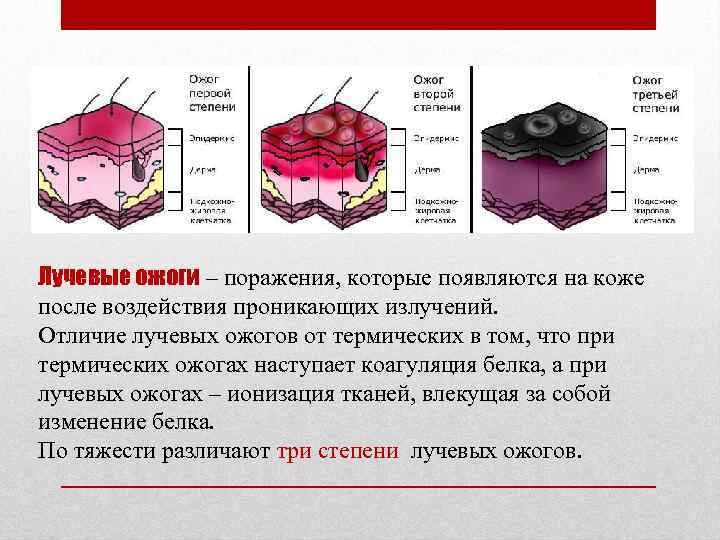 Лучевые ожоги – поражения, которые появляются на коже после воздействия проникающих излучений. Отличие лучевых