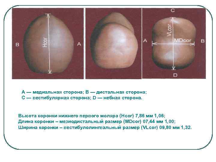 А — медиальная сторона; В — дистальная сторона; С — вестибулярная сторона; D —