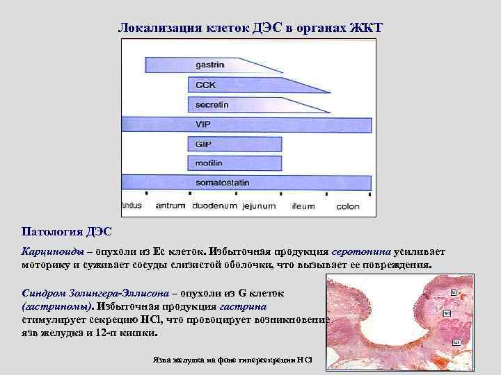 Локализация клеток ДЭС в органах ЖКТ Патология ДЭС Карциноиды – опухоли из Ес клеток.